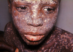 Smallpox: Health Significance And Clinical Manifestations
