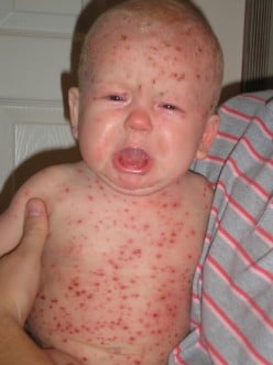 ChickenPox (Varicella): Health Significance To Man, Pathology, epidemiology And Clinical Presentations