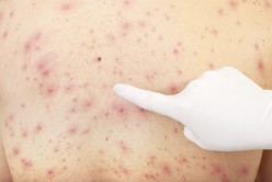 ChickenPox: Clinical Significance Of Its Complications, Diagnosis, Treatment And Prophylaxis