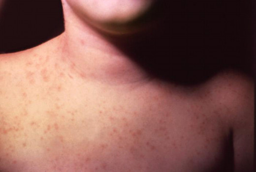 Aspetic meningitis may occur as a result of infection by several strains of ECHO viruses. Signs of meningeal irritation or rise in intracranial tension may be evident. The acute phase may last for 4 to 7 days.