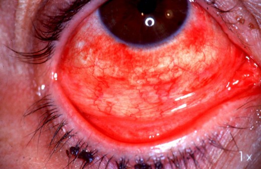 It is characterized by peri-orbital edema, pain, photophobia, blurred vision and conjunctival suffusion. Though the vast majority clear up completely in a week, neurological complications develop in a few cases. These include multiple cranial nerve p