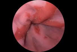 Damage from reflux