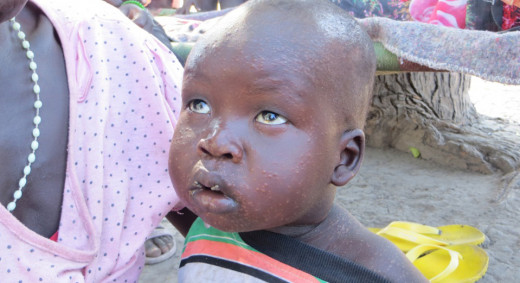 The incubation period is commonly 2 to 6 months, but in exceptional cases it may be longer. The onset may be insidious as in typhoid or abrupt as in malaria. In the enteric type, fever reaches its height in 1 to 2 weeks, and persists continuously. 