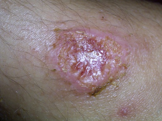 It is confirmed by demonstrating LD bodies in the “slit and scrape material” obtained from the skin lesions and stained by Leishman stain. Further, L. donovani may be grown in NNN medium from material aspirated from the nodules. 