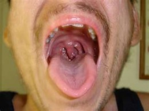 The mouth pictures herpes in The mouth pictures herpes in