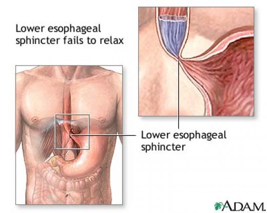 Achalasia is a disorder in which the lower esophageal sphincter
