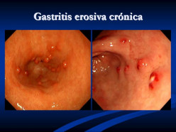 Chronic Gastritis Caused By Helicobacter Pylori Effect: The Story Of Liam Zopper From Sydney, Australia