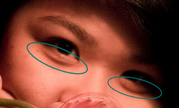 Puffiness below eyes