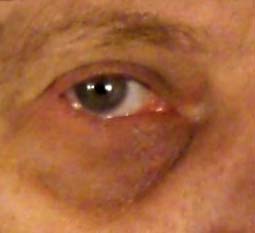 Dark Circles