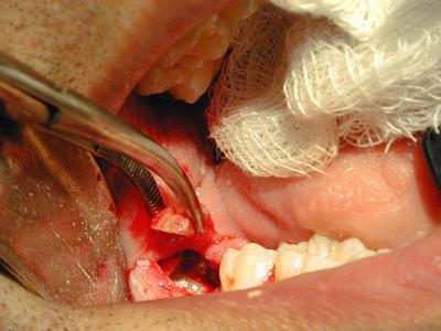 Surgical removal of wisdom tooth