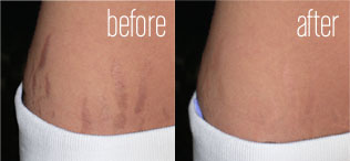 Stretch marks removed - before and after