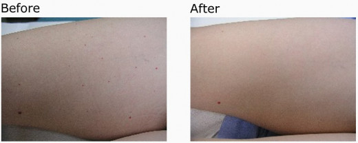Pulsed dye laser treatment before & after