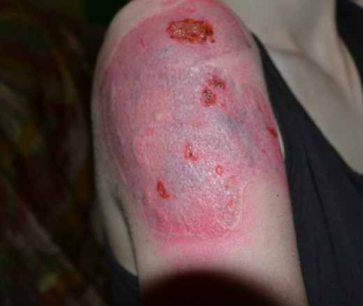 tattoo removal blisters tattoo collections tattoo removal blisters tattoo collections