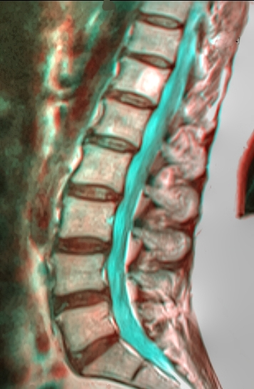 MRI Lumbar
