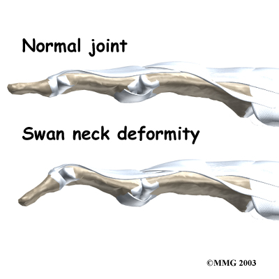 Swan-neck
