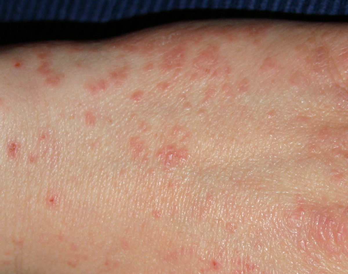 My Atypical Scabies Symptoms Unusual Signs Of Mites That Doctors Don T Recognize Patient S Lounge