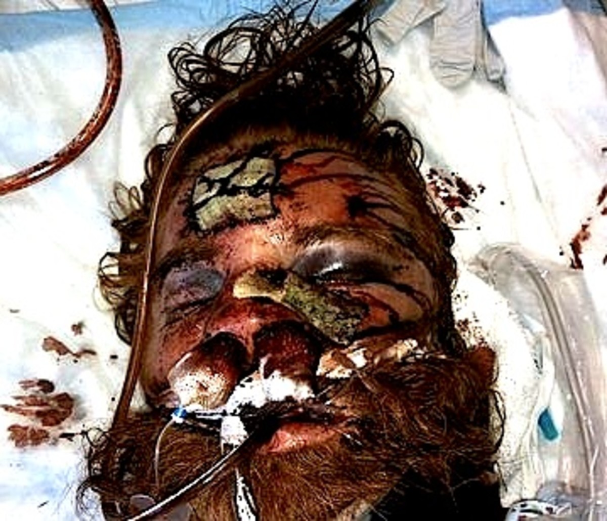 This is how Mr. Thomas looked after his beating as he lay dying in the hospital.