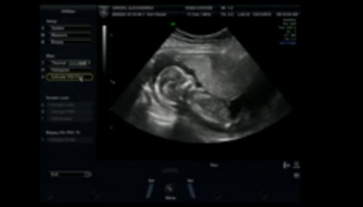 15 weeks pregnant – Ultrasound, Symptoms, Belly Pictures ...