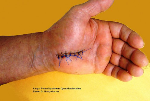 Incision of Carpal Tunnel Syndrome Surgery