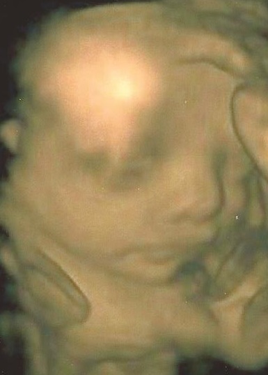 At 28 weeks he is getting plumper and looking more like a newborn. Praise be to God!
