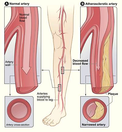 PAD in Legs
