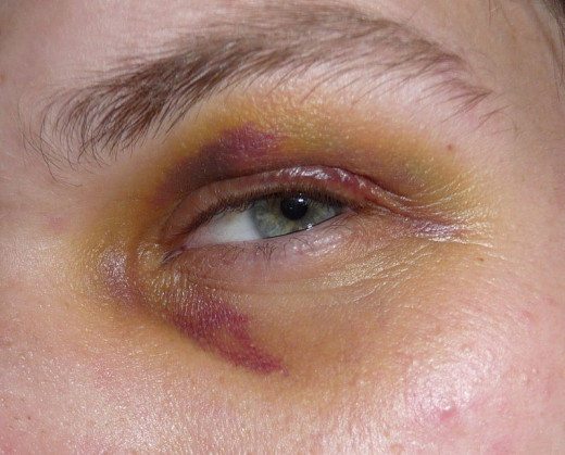 Only a small portion of domestic abuse situations leave marks.