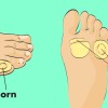 How to Get Rid of Corns On Feet Quickly and Naturally