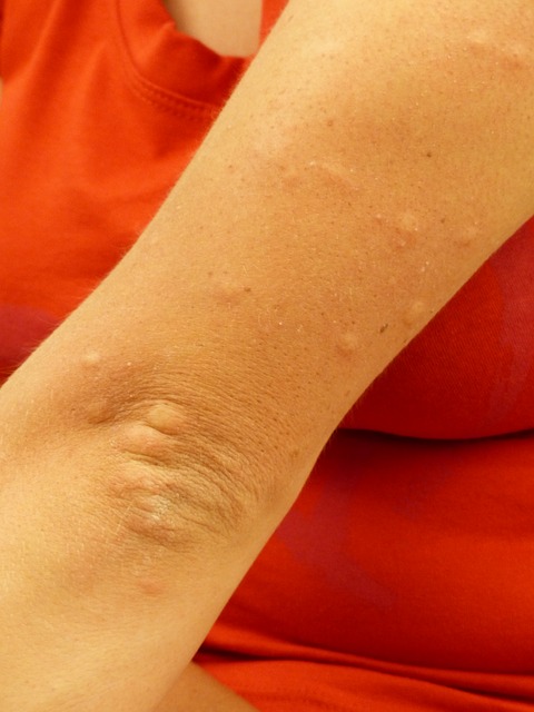 Mosquito Bites