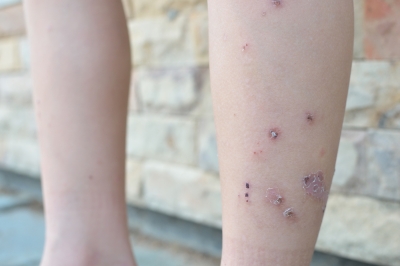 Allergic Dermatitis