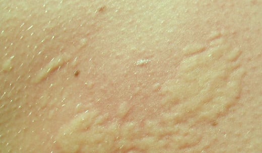 Chlorine rash – Symptoms, Causes, Treatment, Pictures | hubpages