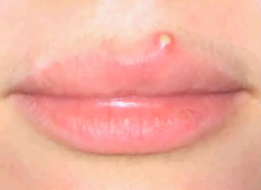 pimple-on-lip-line-hubpages