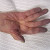 Bluish and possibly numb fingertips due to low levels of oxygen in the blood Bluish and possibly numb fingertips due to low levels of oxygen in the blood