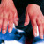 After chilblains, numbness in the fingers may persist for several days After chilblains, numbness in the fingers may persist for several days