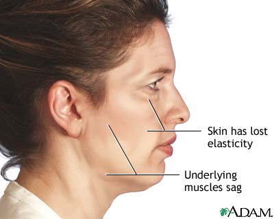 Sagging or wrinkled skin happens naturally with advancing age. Folds and fat deposits appear around the neck. The jawline grows jowly. Deep creases may appear from nose to mouth. Graphics Courtesy the National Institutes of Health.