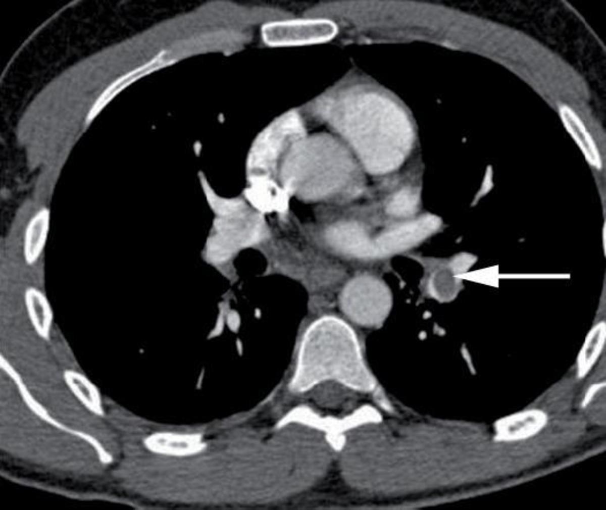 Recovering From A Pulmonary Embolism - What To Expect During Pulmonary Embolism Recovery