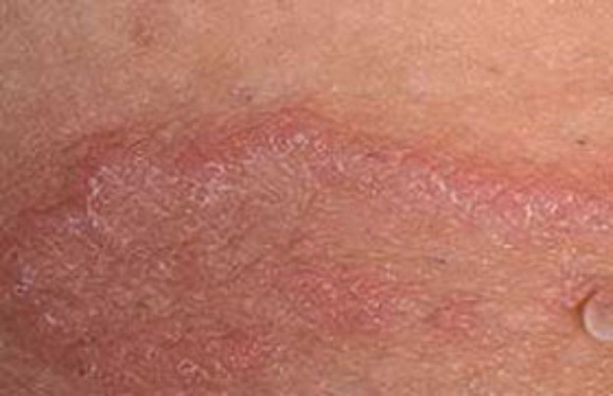 What Is Jock Itch And What To Do About That Red Itchy Penile Skin