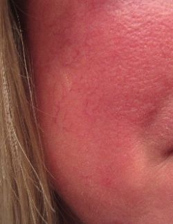 Finally! A Real Answer For Why Is My Face Always Red And Flushed - tp1djbj