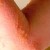 photo: poison-ivy.org Allergic reaction - blisters from contact with poison ivy photo: poison-ivy.org Allergic reaction - blisters from contact with poison ivy