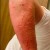 photo: poison-ivy.org Allergic reaction on arm from contact with poison ivy photo: poison-ivy.org Allergic reaction on arm from contact with poison ivy