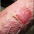 photo: poison-ivy.org Skin on arm drying out as large blisters subsided - not a pretty sight photo: poison-ivy.org Skin on arm drying out as large blisters subsided - not a pretty sight