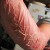 photo: poison-ivy.org Skin on arm drying out as large blisters subsided photo: poison-ivy.org Skin on arm drying out as large blisters subsided
