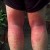 photo: poison-ivy.org Allergic reaction to poison ivy after skin contact on back of legs photo: poison-ivy.org Allergic reaction to poison ivy after skin contact on back of legs