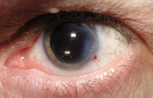 Cataract surgery recently performed