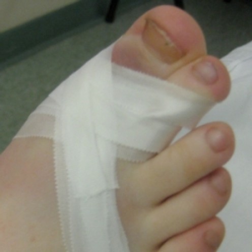 How to Straighten Crooked Toes Without Surgery How to Straighten Crooked Toes Without Surgery